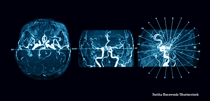 mri intracerebral hemorrhage